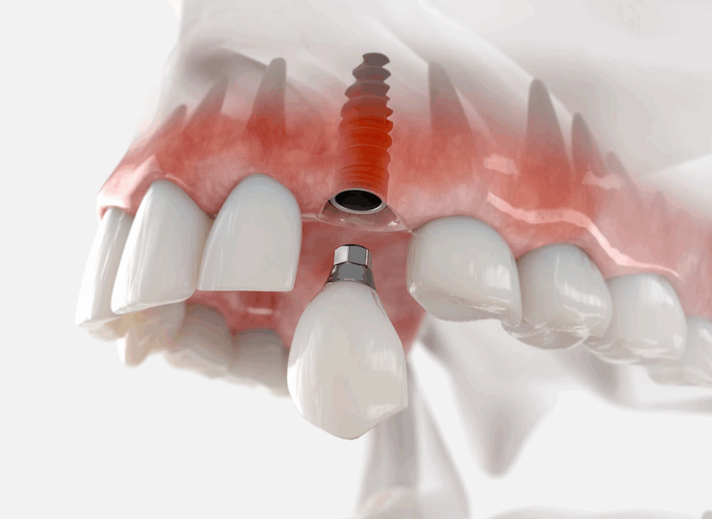 What is a Dental Implant and Why is it Needed?